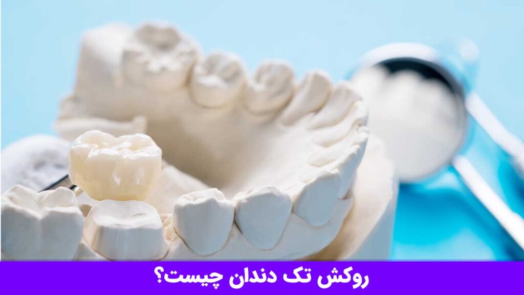 روکش تک دندان چیست؟