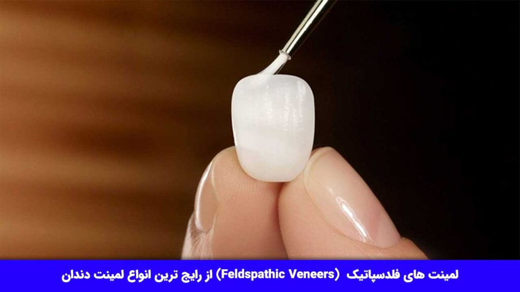 لمینت دندان فلدسپاتیک  (Feldspathic Veneers)