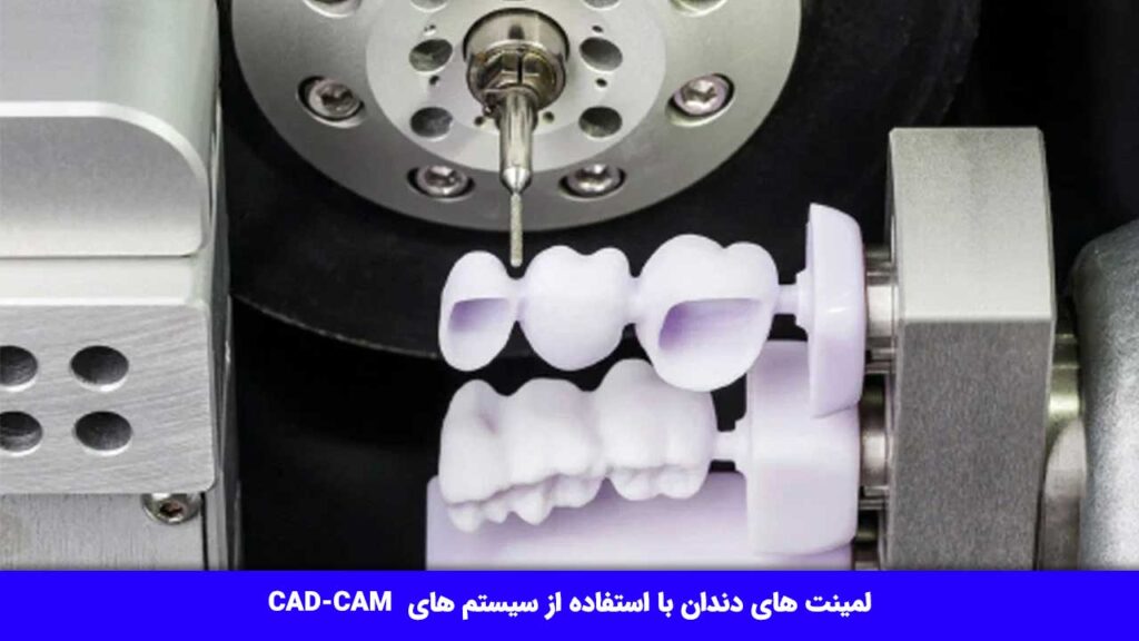 لمینت های دندان با استفاده از سیستم های  CAD-CAM