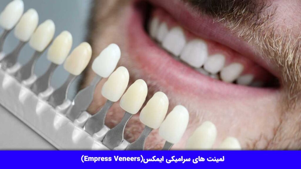 لمینت های سرامیکی ایمکس(Empress Veneers)