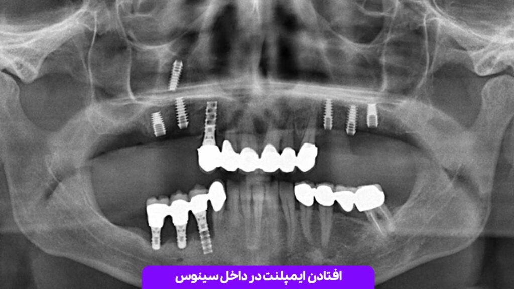 افتادن ایمپلنت در داخل سینوس