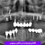 افتادن ایمپلنت در داخل سینوس