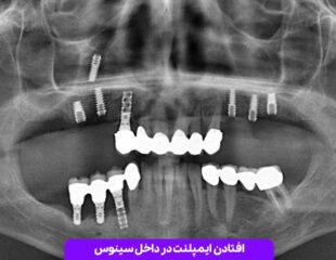 افتادن ایمپلنت در داخل سینوس