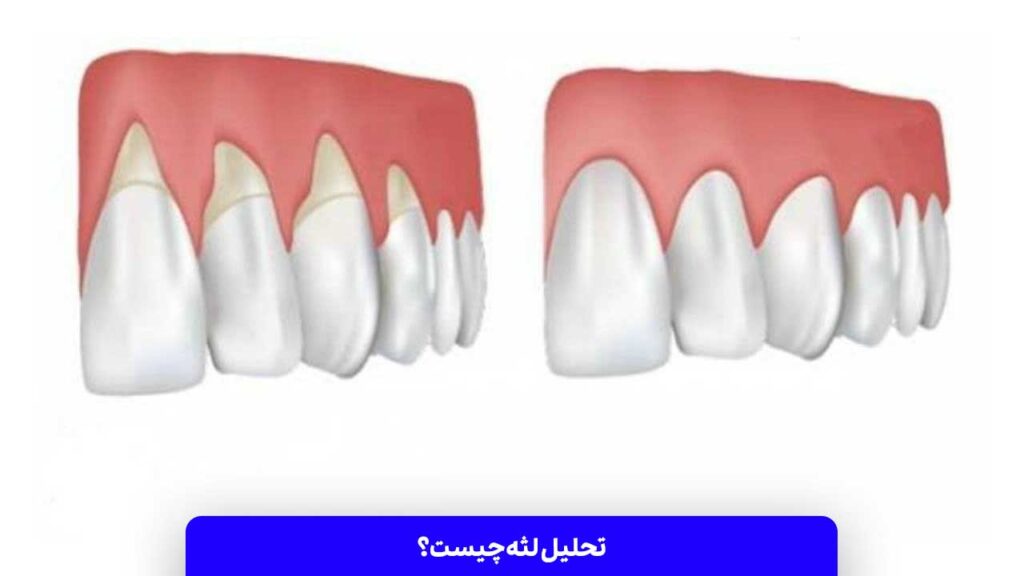 تحلیل لثه چیست؟