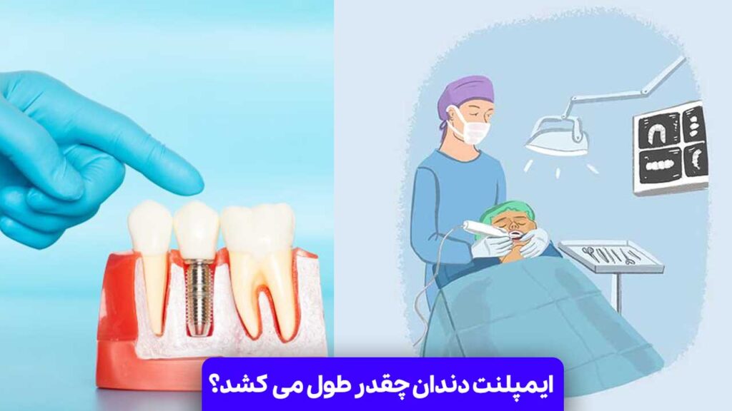 ایمپلنت دندان چقدر طول می کشد