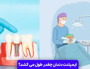 ایمپلنت دندان چقدر طول می کشد