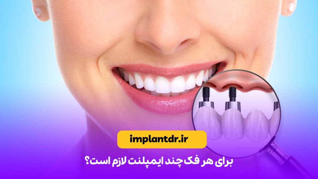 برای هر فک چند ایمپلنت لازم است؟