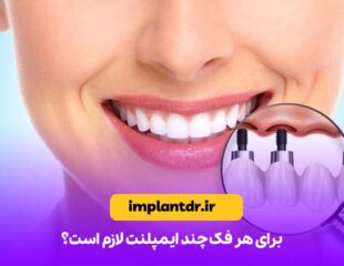 برای هر فک چند ایمپلنت لازم است؟