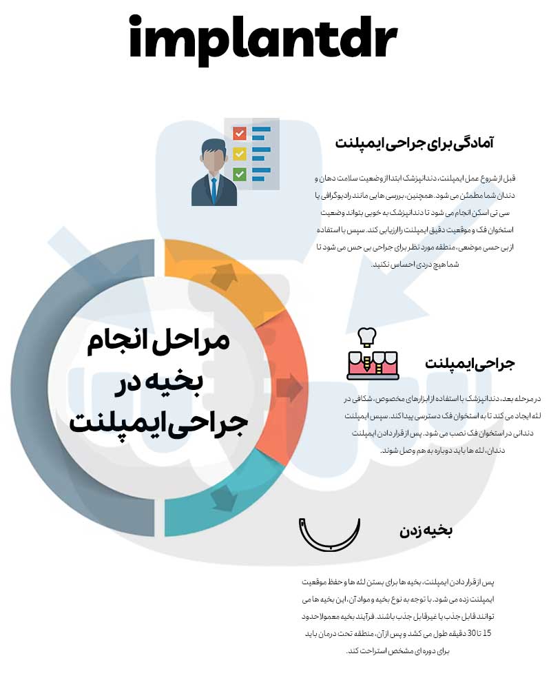 مراحل انجام بخیه در جراحی ایمپلنت