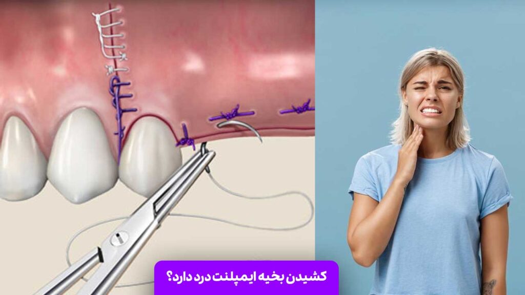 کشیدن بخیه ایمپلنت درد دارد؟