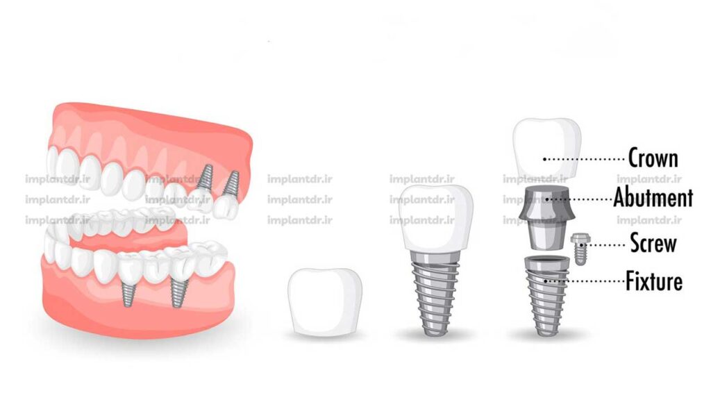 ایمپلنت دندان چیست؟