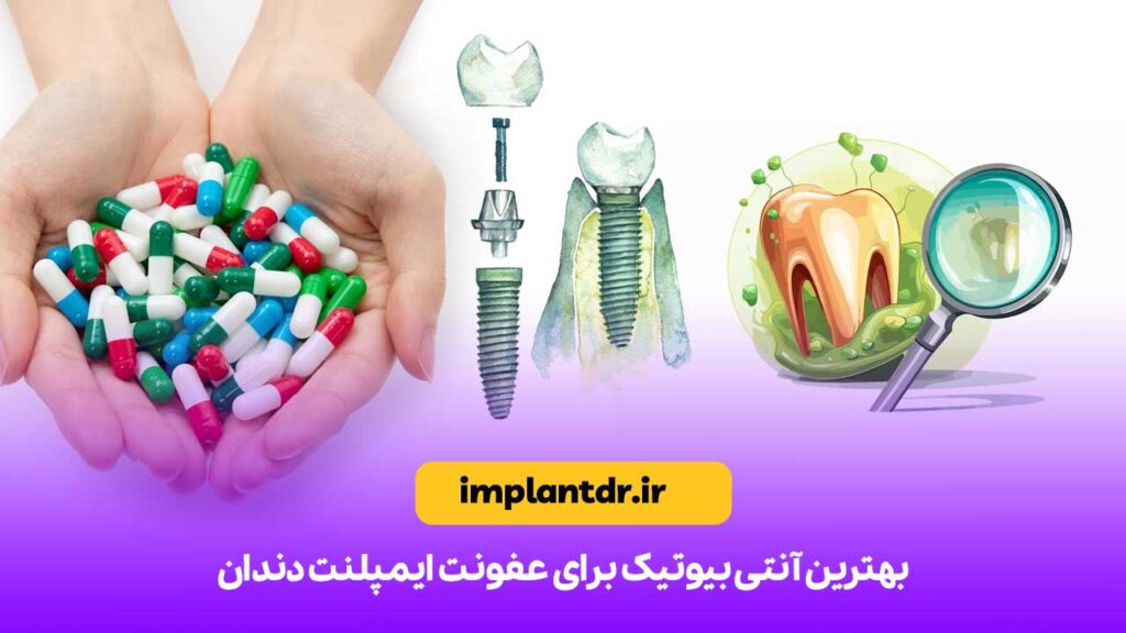 بهترین آنتی بیوتیک برای عفونت ایمپلنت دندان