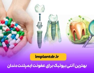 بهترین آنتی بیوتیک برای عفونت ایمپلنت دندان