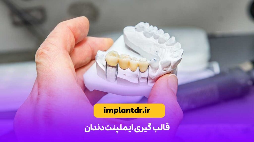 قالب گیری ایمپلنت دندان