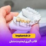 قالب گیری ایمپلنت دندان