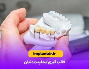 قالب گیری ایمپلنت دندان