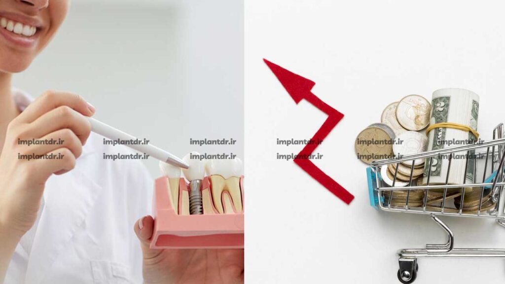 هزینه قالب گیری ایمپلنت در سال 1403