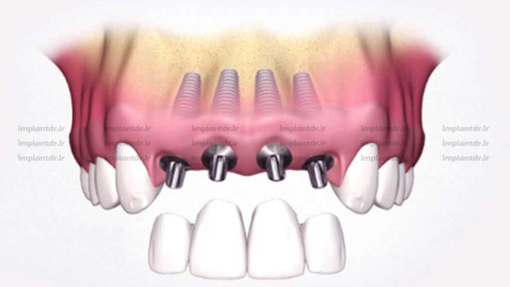 ایمپلنت های چندگانه و پروتزهای ثابت