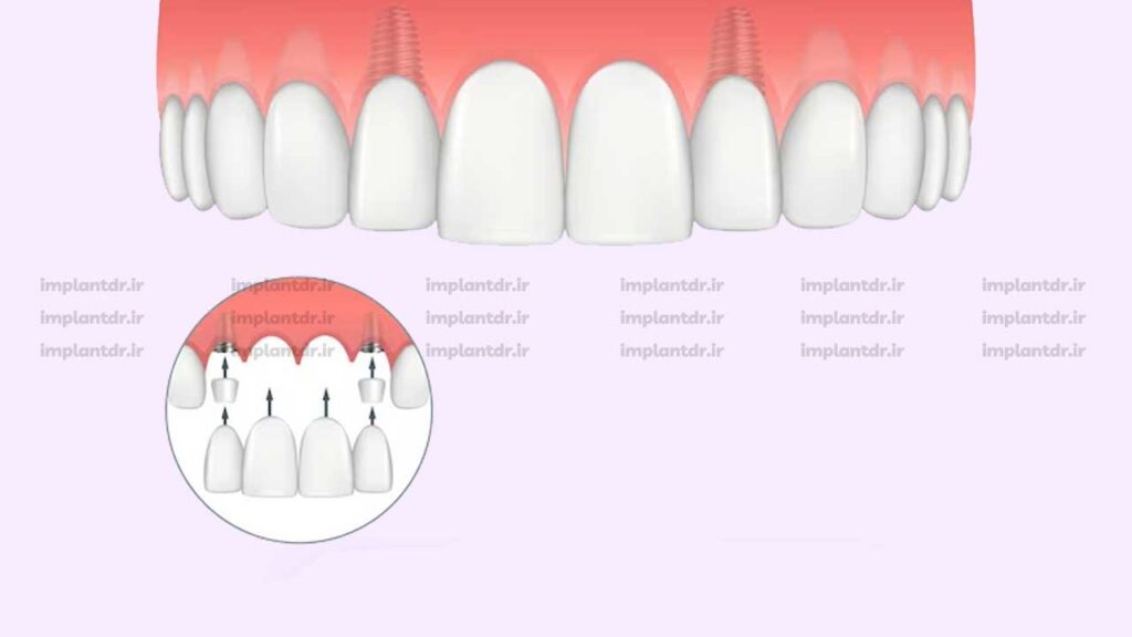 برای فک بالا چند ایمپلنت لازم است؟
