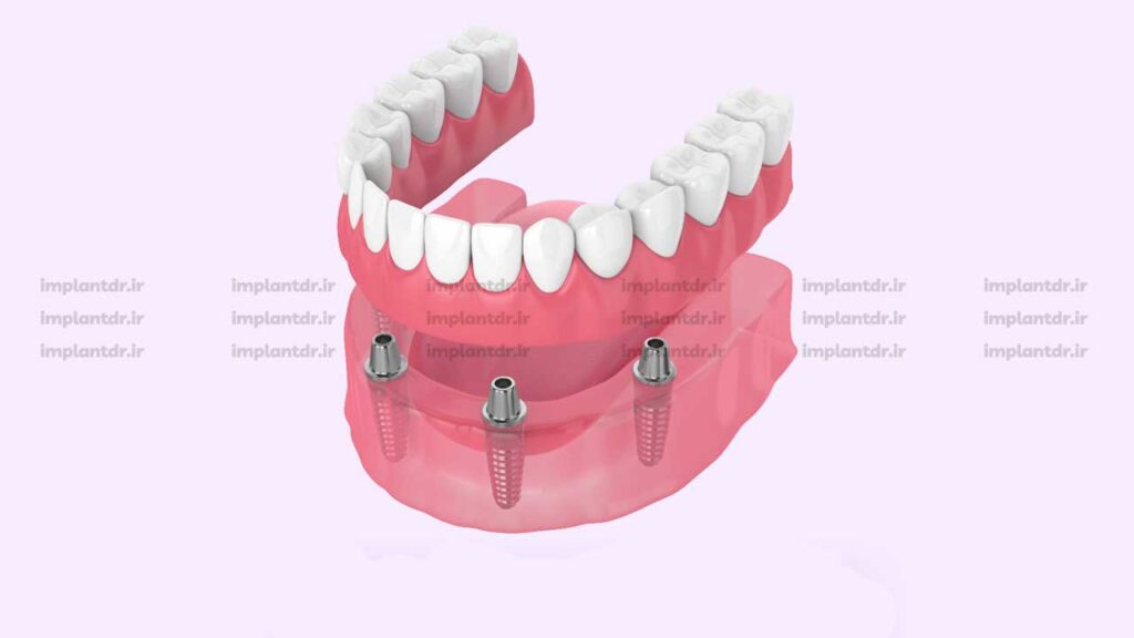 برای فک پایین چند ایمپلنت لازم است؟