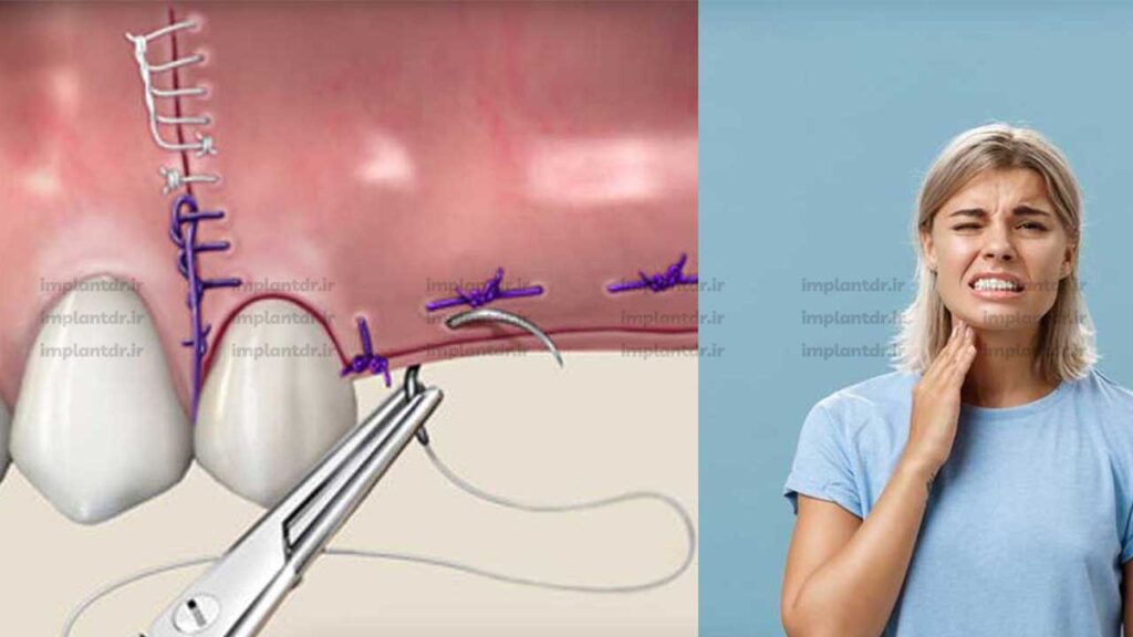 کشیدن بخیه ایمپلنت درد دارد؟