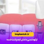 ارتودنسی دندان ایمپلنت شده