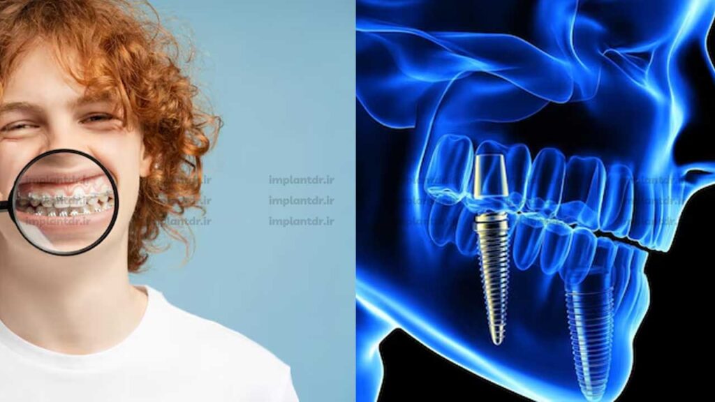 بررسی وضعیت ایمپلنت و فک قبل از انجام ارتودنسی