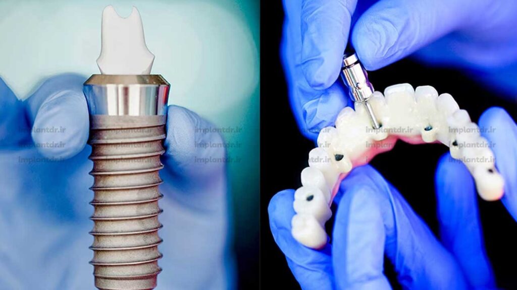 درمان پیشرفته ایمپلنت دیجیتال