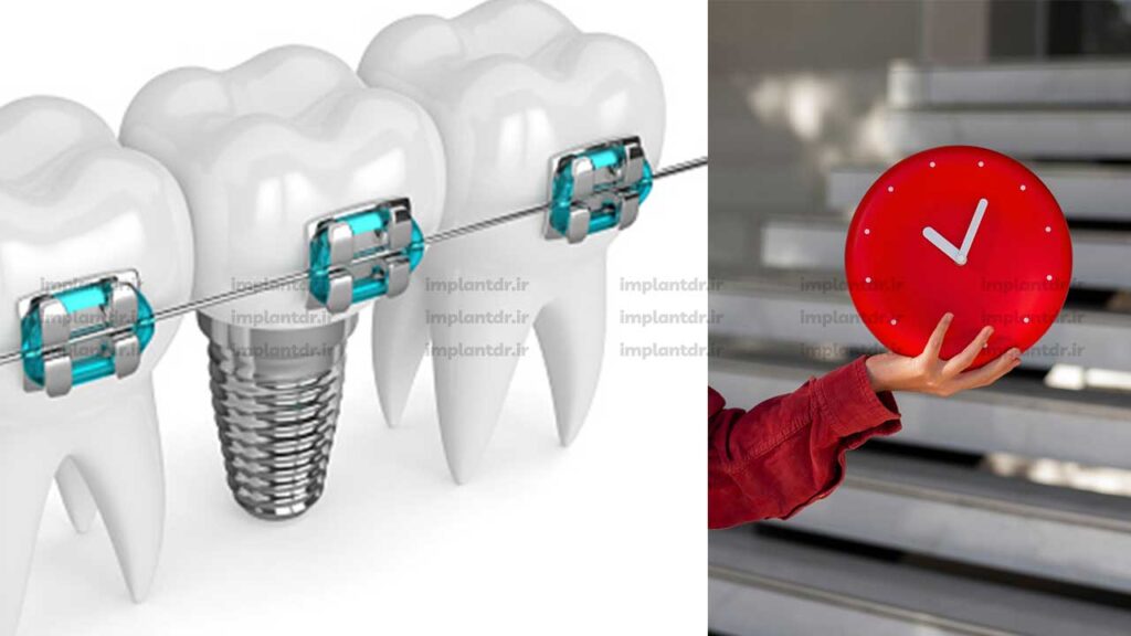 زمان مناسب برای شروع ارتودنسی دندان ایمپلنت شده