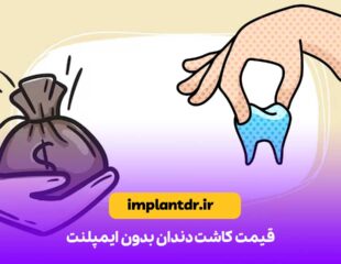 قیمت کاشت دندان بدون ایمپلنت