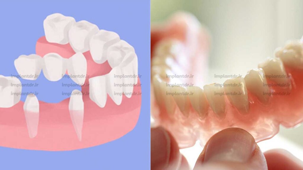 قیمت کاشت دندان بدون ایمپلنت وابسته به نوع روش