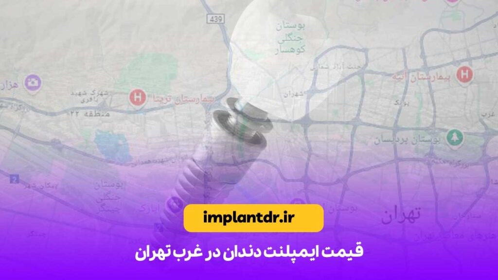 قیمت ایمپلنت دندان در غرب تهران