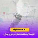 قیمت ایمپلنت دندان در غرب تهران